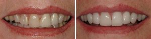 Teeth before and after porcelain veneers.