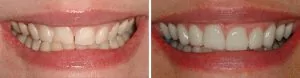 Cosmetic dentistry in Chattanooga.