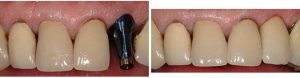 A before and after dental implant treatment example.