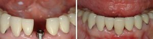 Before and after dental implant installation, a restorative dentistry technique.