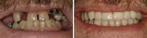 Full Mouth Reconstruction real patient before and after photo in Chattanooga, TN
