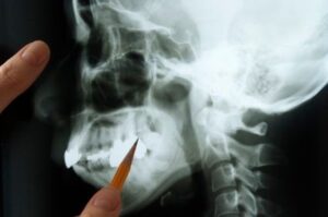 An X-ray of a jawbone being examined.