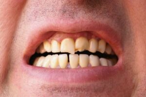A man with visibly cracked and broken teeth.