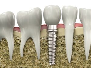A graphic image of a dental implant placed in Chattanooga.